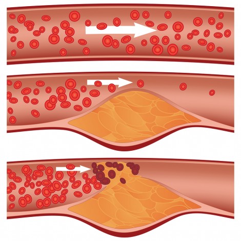 Illustration of an Artery blocked with bad cholesterol